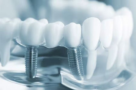 implante dentário