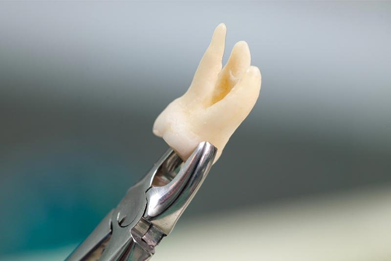 extração de dentes com problemas