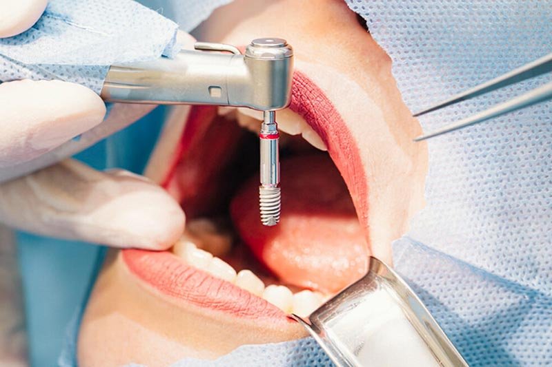 o que é cirurgia oral e quando é necessária