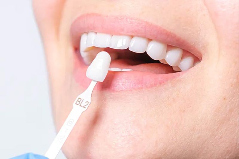 restaurar dente com faceta de resina