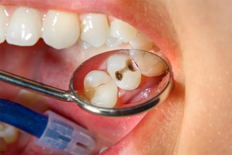 tratamento para dente careado